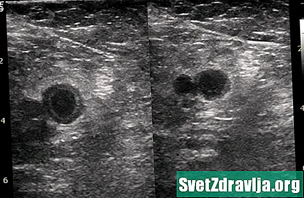 Diagnostika DVT pomocí ultrazvuku: Co lze očekávat