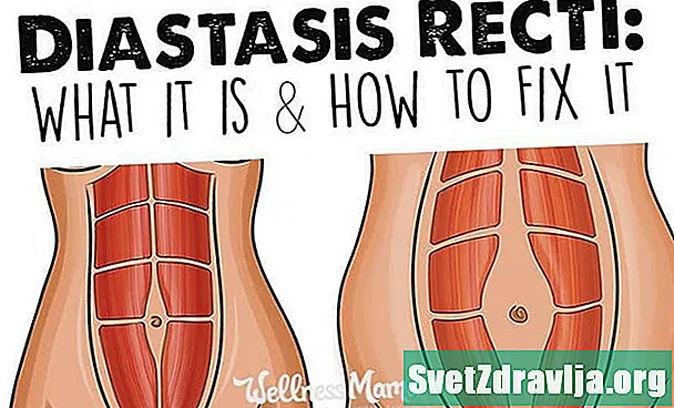 Diastasis Recti : 무엇이며 어떻게 치료됩니까?