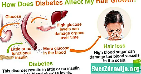 Да ли дијабетес узрокује губитак косе?
