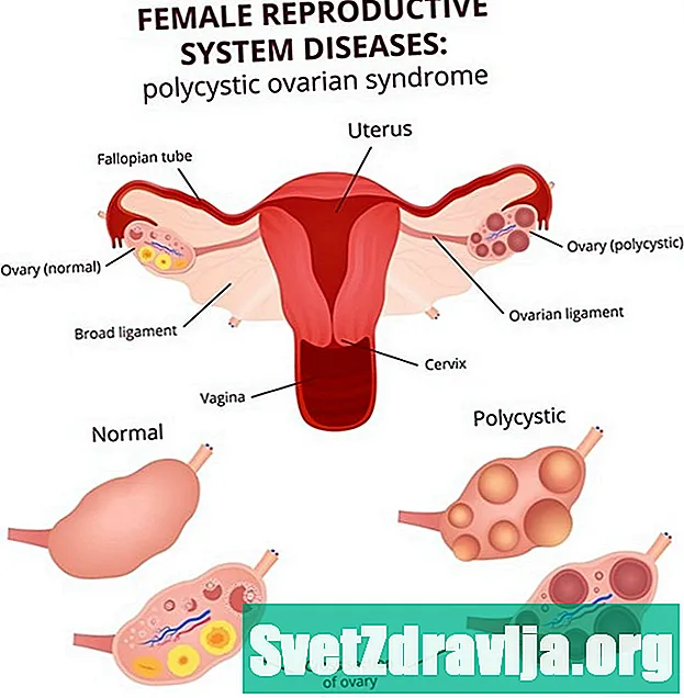 Påvirker overgangsalderen polycystisk ovariesyndrom (PCOS)?