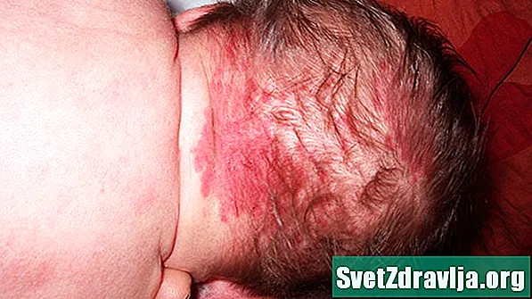 私の赤ちゃんにはコウノトリの咬傷の母斑がありますか？