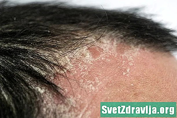 Adakah Psoriasis Menyebabkan Rambut Gugur?