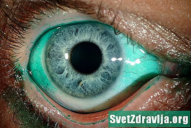 Torra ögonsyndrom - Hälsa