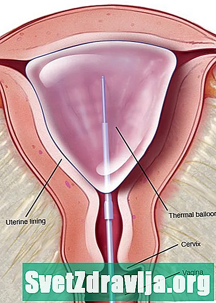 Endometriumin ablaatio: mitä odottaa