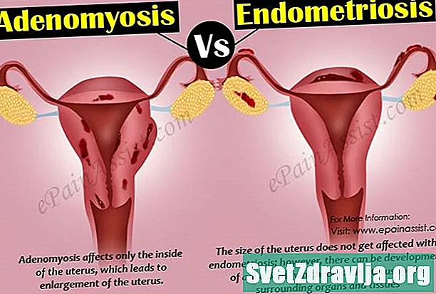Endometriose vs. Adenomiose: semelhanças e diferenças