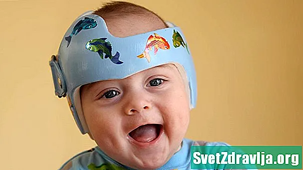 Oletko koskaan nähnyt vauvan kypärässä? Tässä on miksi - Terveys