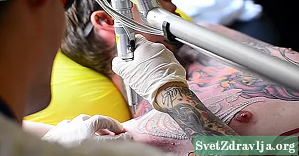Сè што треба да знаете за отстранување на тетоважи
