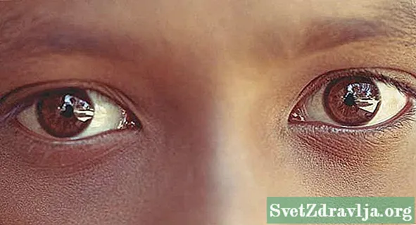 Göz Kapağı Dermatiti Hakkında Bilmeniz Gereken Her Şey
