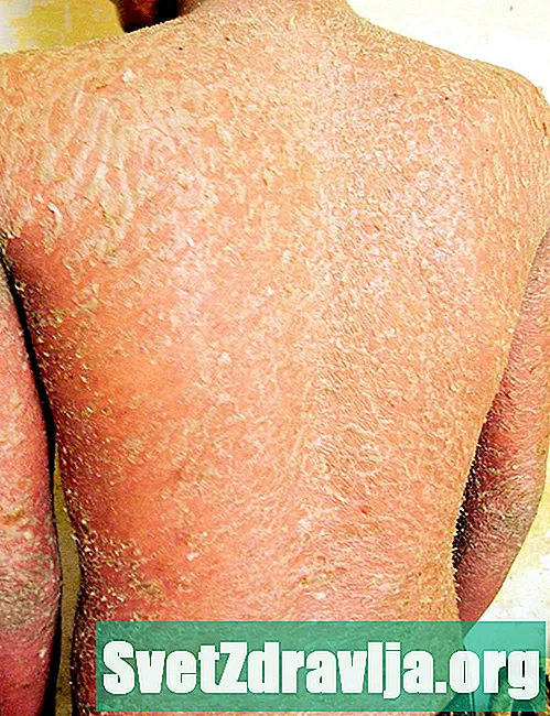 Kuorinta aiheuttava dermatiitti