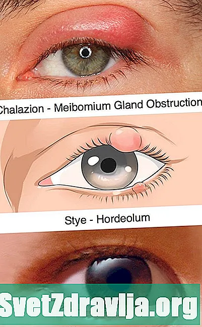 Ulkoinen silmäluomen kauneus (Hordeolum Externum) - Terveys