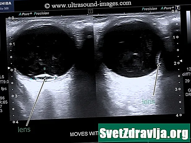 Ultrazvuk za oči i orbitu - Zdravlje