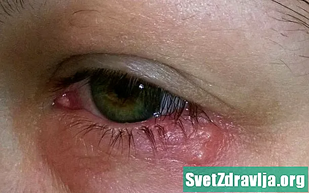 Øyeskuld: symptomer, årsaker og behandlinger