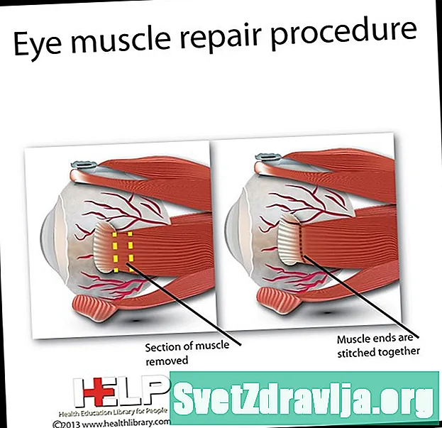 Kirurgji për riparimin e muskujve të syrit - Shëndetësor