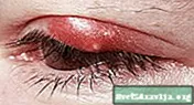 Inflammation i ögonlocket (blefarit)