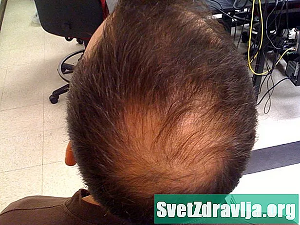 Kvennamynstur Baldness (androgenic Alopecia): Það sem þú ættir að vita