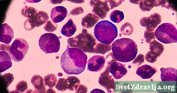 FLT3 Mutation ug Acute Myeloid Leukemia: Mga Konsiderasyon, Pagkaylap, ug Pagtambal - Panglawas