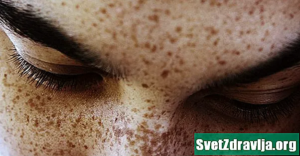 Freckles: abinõud, põhjused ja palju muud - Tervis