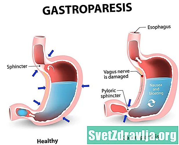 Gastroparéza - Zdraví