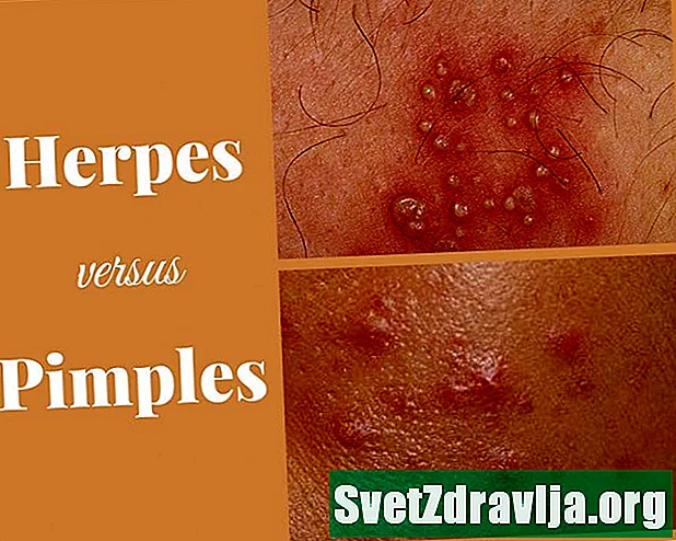 Mụn nhọt ở bộ phận sinh dục so với Herpes: Cách xác định và điều trị các triệu chứng của bạn