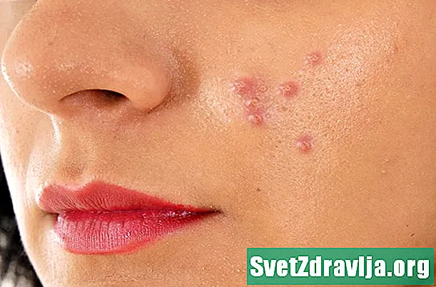 Sərt pimples: səbəbləri, müalicəsi və sair