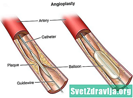 Angioplastia cardíaca y colocación de stent - Salud
