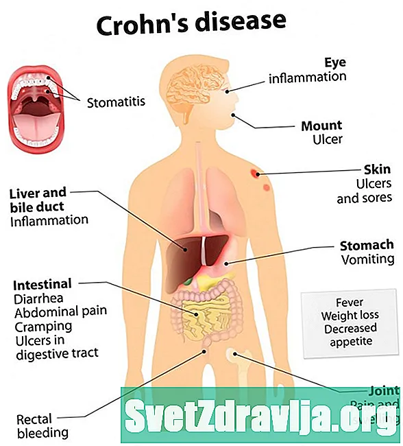 Điều trị giun sán cho bệnh Crohn