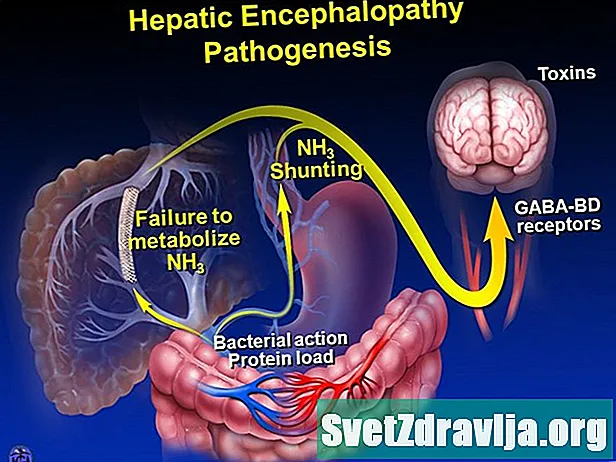 Encefalopatie hepatica