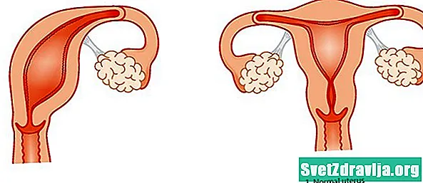 Unicornuate uterus hamiləliyə necə təsir edir - Sağlamlıq