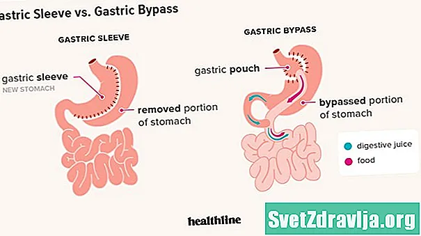 Hogyan különböznek a gyomor hüvely és a gyomor bypass műtétek?