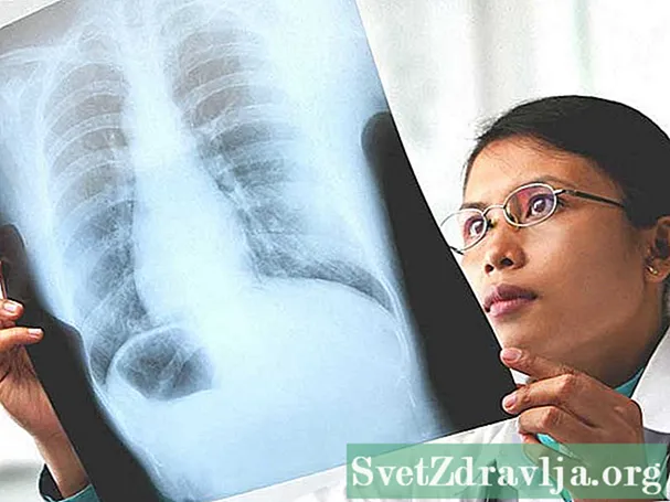 Làm thế nào để X-Rays giúp chẩn đoán COPD?