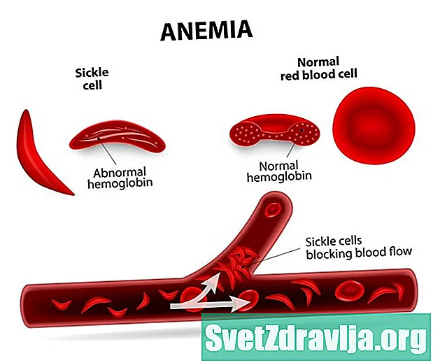 Hogyan befolyásolja a sarlósejtes vérszegénység az élettartamot? - Egészség
