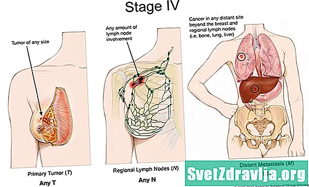 Kuidas 4. etapi rinnavähk võib viia kopsupõletikku - Tervis
