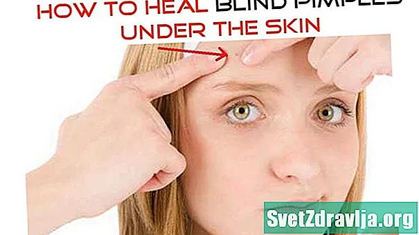 Jak léčit slepé pupínky pod kůží: 6 způsobů