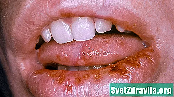 Wéi een Herpes am Tongue identifizéiert a behandelt - Gesondheet
