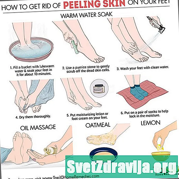 Kaip sustabdyti odos lupimąsi