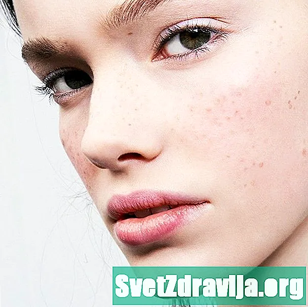 Come trattare l'iperpigmentazione della pelle in modo naturale