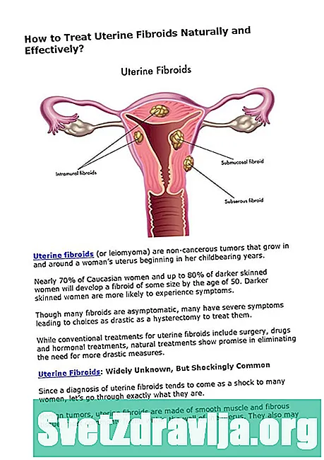 Hur du behandlar livmodern fibroids själv - Hälsa