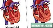 Hipertenzivna bolest srca