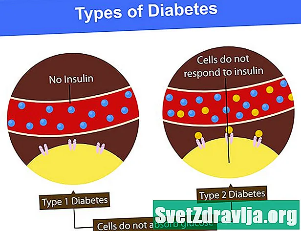 저혈당증 및 제 2 형 당뇨병