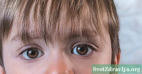 Rausvos akies nustatymas ir gydymas mažiems vaikams
