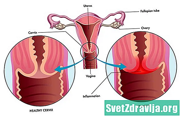 Възпаление на шийката на матката (Cervicitis)