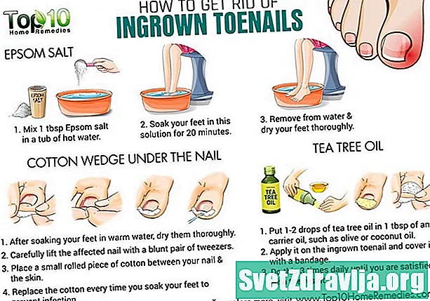 Inngrodde toenail: rettsmidler, når du skal oppsøke legen din og mer - Helse
