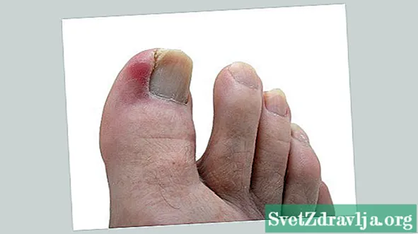 Врастнали нокти на краката: Защо се случват?