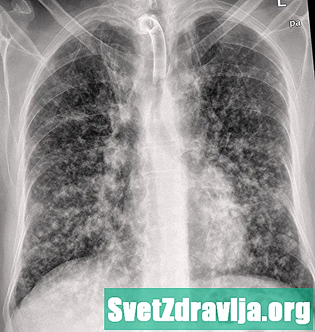 Intersticijska bolest pluća