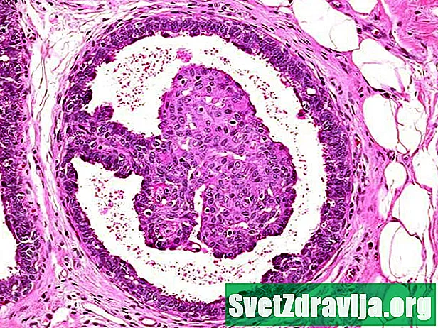 Intraductaal papilloma