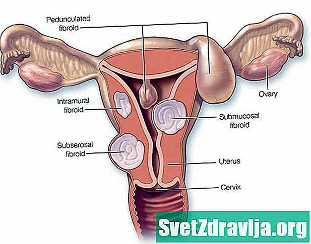 Intramurální fibroid - Zdraví