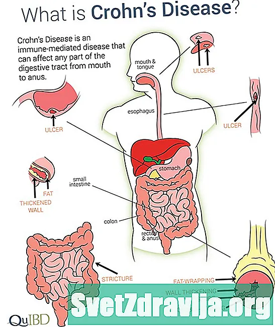 Hướng dẫn về hướng nội đối với bệnh Crohn
