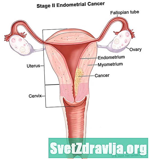 ¿Es el cáncer de endometriosis?