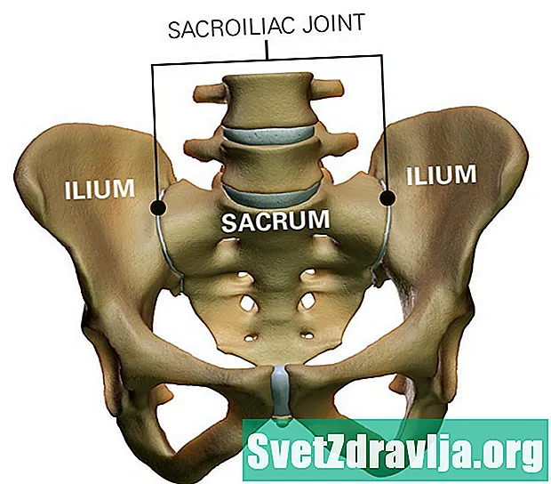 Ali vaš sklep SI povzroča bolečino v spodnjem delu hrbta?