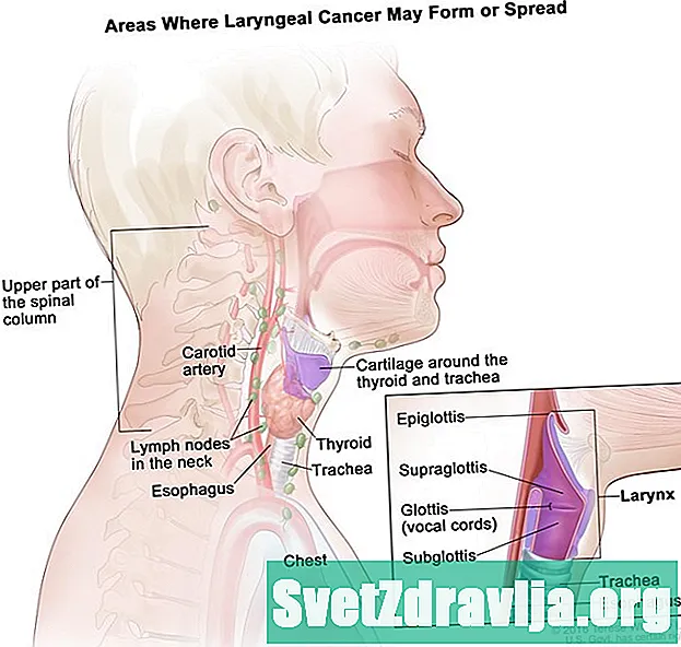 Càncer de laringe